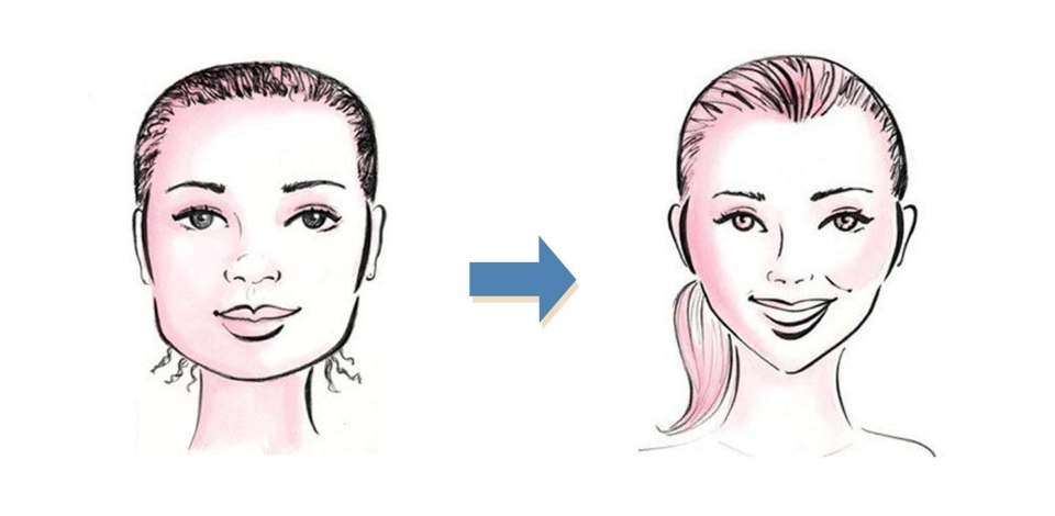 Niềng răng làm thay đổi khuôn mặt từ mặt vuông sang mặt v-line